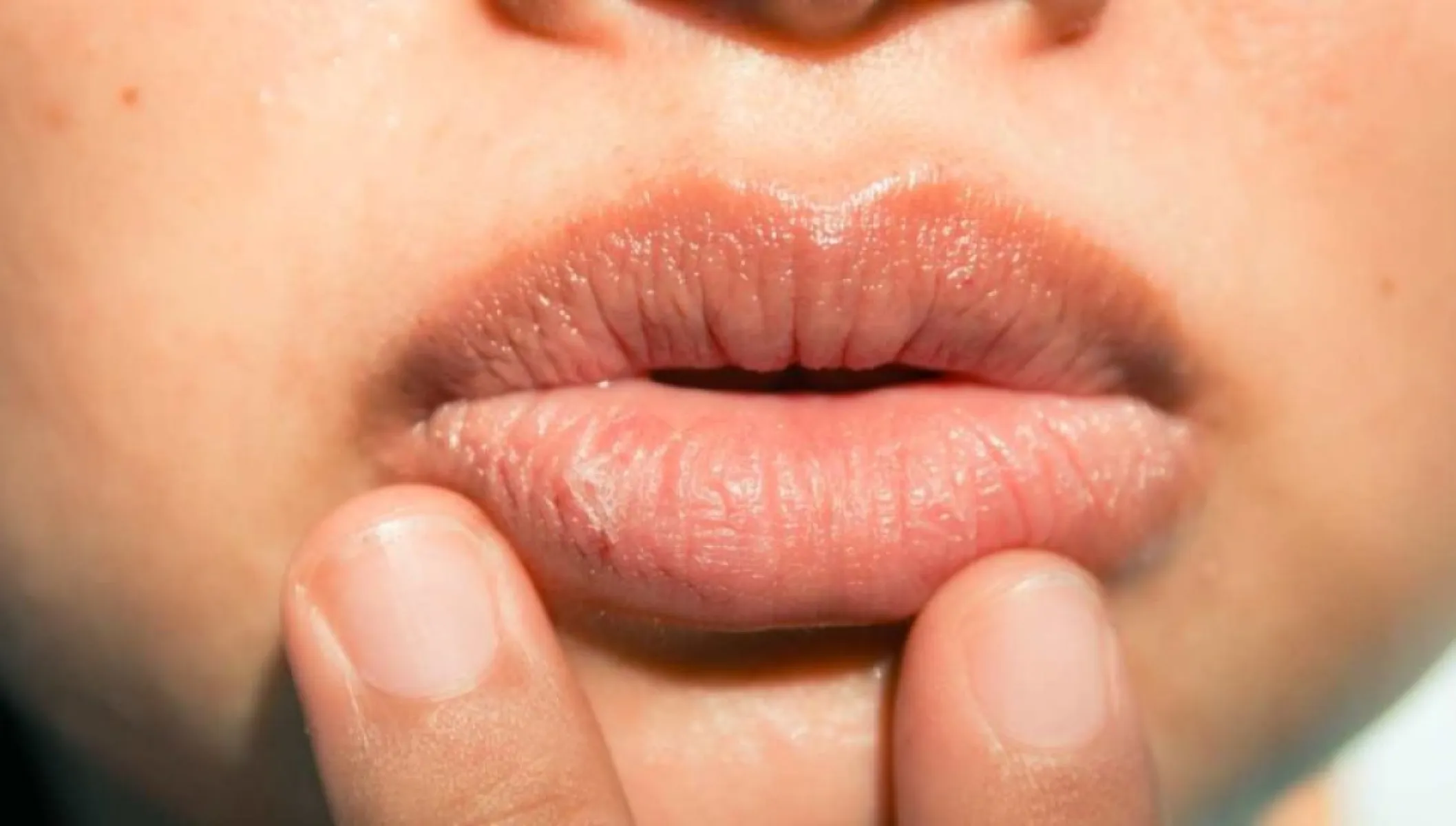 Lip Filler Albania – Safe & Natural Aesthetic Treatments - Foto 1